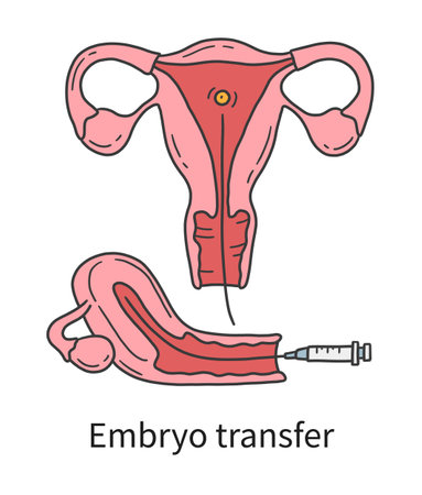 Embryo transfer into a womans uterus at In Vitro fertilizationのイラスト素材