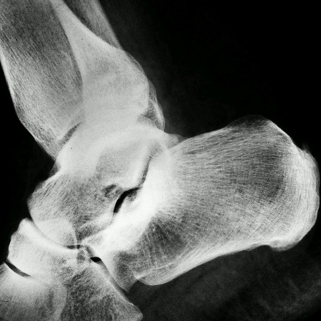 Human rentgen photo leg.の素材