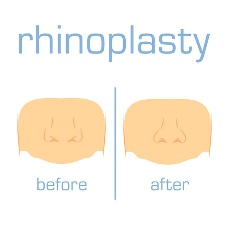 Vector illustration rhinoplasty operation form nose. Aesthetic plastic surgery beauty. Correction hump nose on white background.のイラスト素材