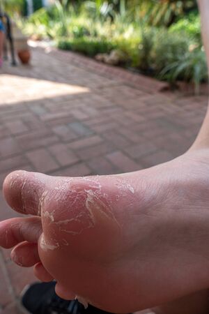 the skin detaches from one foot due to an illnessの写真素材