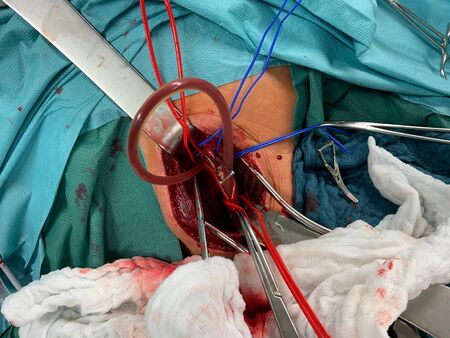 In carotid surgery, the ateria carotis is exposed and wrapped in red and blue reinsの写真素材