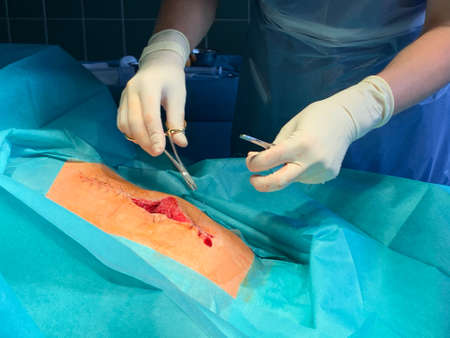 a doctor sews up a wound on the abdomen with a needle holder and surgical suture materialの写真素材