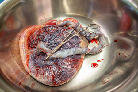 A placenta with umbilical cord is in a silver saline bowl after a birthの写真素材