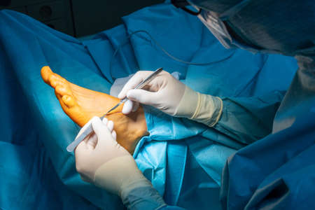 surgeon makes an incision on one foot with a scalpelの写真素材
