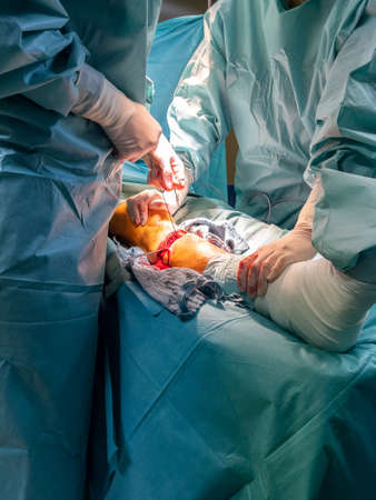in an operating room lower leg amputation is performedの写真素材