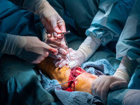 in an operating room lower leg amputation is performedの写真素材