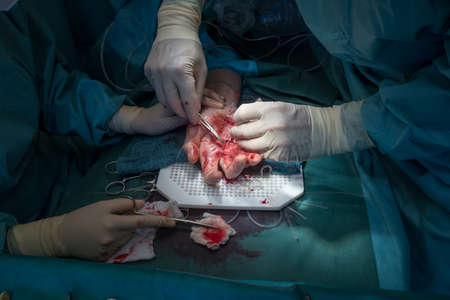 a doctor performs a hand surgery operationの写真素材