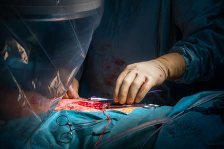 Two explanted cleaned silicone breast implants lie on a green surgical drape