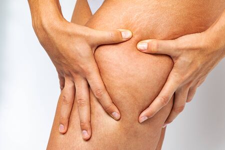 Close up of hands showing cellulite and stretch marks on female thigh.の写真素材