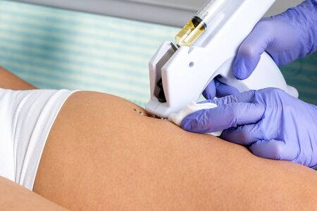 Extreme close up detail of therapist doing mesotherapy on female upper thigh with micro needle gun.の写真素材