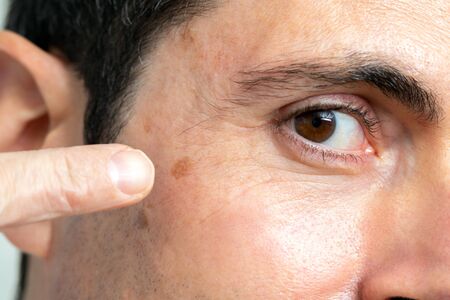 Macro close up detail of facial melanoma on middle aged man. Hand pointing with finger at mole next to eye.の写真素材