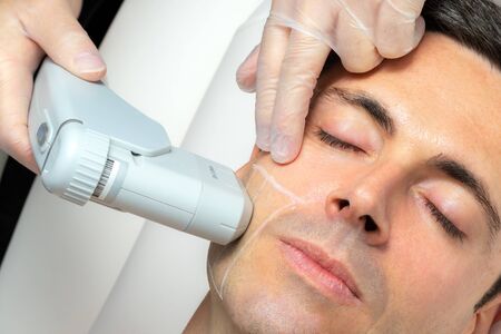 Close up top view portrait of middle aged man having cosmetic facial high intensity focal ultrasound treatment on cheek.の写真素材