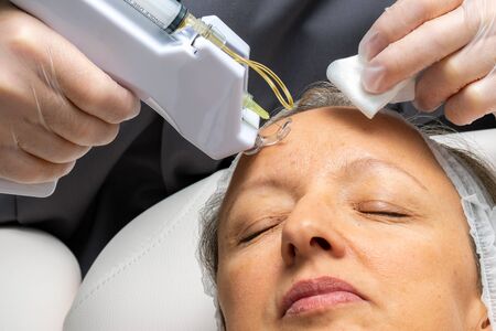 Macro close up middle aged woman having cosmetic facial plasma lift with micro needle gun.