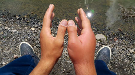 Swollen hand. Allergy to bee stings. Two hands of a personの写真素材
