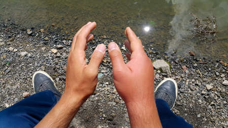 Swollen hand. Allergy to bee stings. Two hands of a personの写真素材