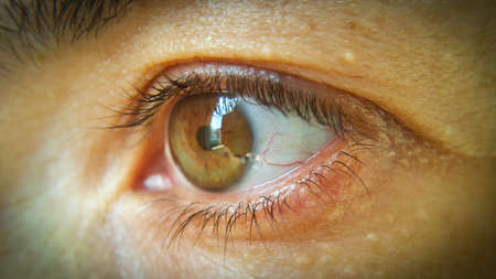 Blood vessel on the eyeball. Intraocular pressure. Bloodshot eyes. Close-up macro photography. Bleeding damage to the eye.の写真素材