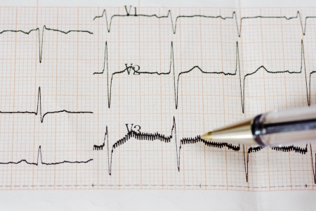 Excitedly heart. Mild sings of arrhythmia. Close up of ECG graph.の写真素材