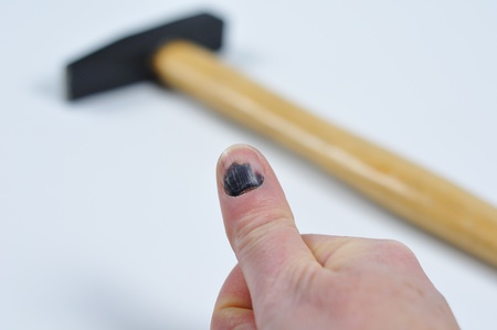 Blue fingernail, after a blow with the hammer.の写真素材