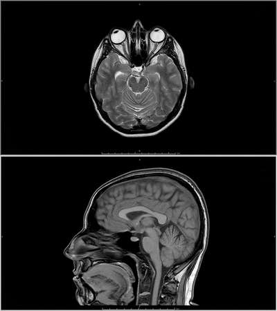 MRI scan or magnetic resonance image of head. Problems with the brain stem and pituitary gland.