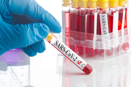 Blood test. Positive virus result. SARS-CoV-2の写真素材