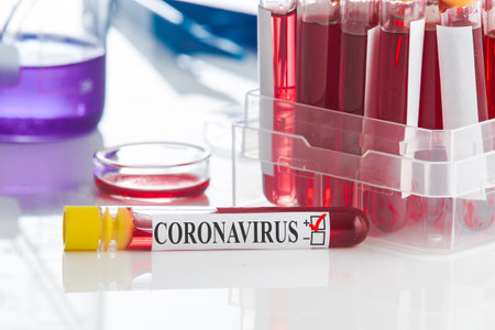 blood tests. Positive coronavirus result. SARS-CoV-2の写真素材