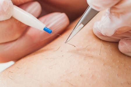 The process of permanent unwanted hair removal, using an electroepilation device and tweezers.の写真素材