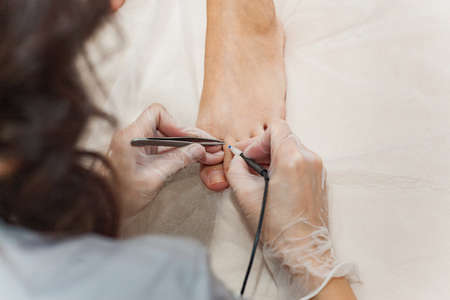 The process of permanent removal of unwanted hair on the toes using an electroepilation device and tweezers.の写真素材