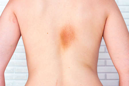 Caucasian woman back with Idiopathic Atrophoderma of Pasini and Pierini and systemic scleroderma brown spot disease. Asymptomatic atrophic hyperpigmented plaque on the skin.の写真素材