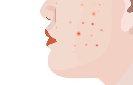 Pimple on woman face skin on white background vectorのイラスト素材