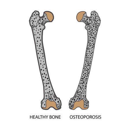 X-ray compare osteoporosis and healthy bone , illustration on white backgroundの写真素材