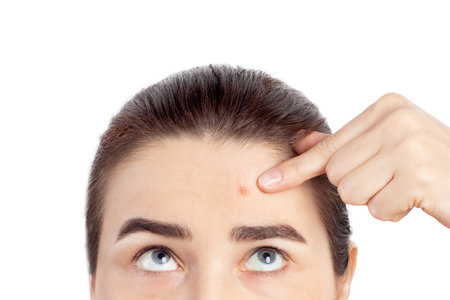 Woman shows a finger to a red pimple on her face health problems acne. problematic skin. Close-up photo on a white backgroundの写真素材