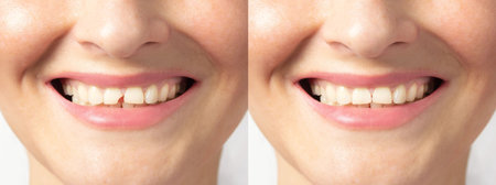 Collage photo of repair, fix tooth at dentist. Smile with broken teeth.