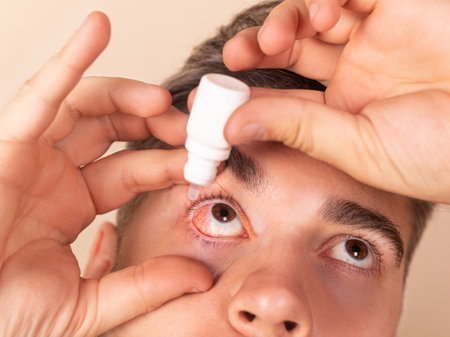 Close up man pours drops in red eye, has conjuctivitis or glaucoma, bad eyesight and pain. Eyes pain treatment concept. Man cures red blood eyeの写真素材