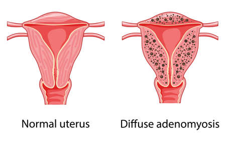Diffuse Adenomyosis Human anatomy Female Sick vs normal reproductive system organs. Location Cross section scheme uterus vagina icon. Vector illustration disease disorder isolated medical reproductionのイラスト素材