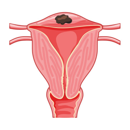 Focal Adenomyosis Human anatomy Female reproductive Sick system, organs. location scheme uterus icon. Vector medical illustration isolated on white background. Cross section of an internal organ.のイラスト素材