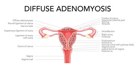 Diffuse Adenomyosis with inscriptions, Human anatomy Female reproductive Sick system organs. Structure of uterus, cervix, ovary, fallopian tube in Latin text. Frontal view in a cut Vector illustrationのイラスト素材