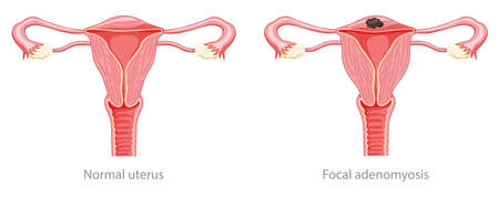 Focal Adenomyosis Human anatomy Female Sick and normal reproductive system organs. Location scheme Cross section uterus, cervix, ovary, fallopian tube icon. Vector illustration isolated on whiteのイラスト素材