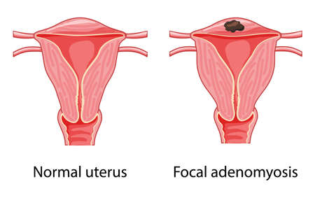 Focal Adenomyosis Human anatomy Female reproductive system diagram with text Sick and normal organ uterus vagina Cross section icon. Vector carton flat illustration isolated on white backgroundのイラスト素材