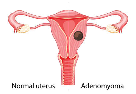 Adenomyoma Adenomyosis Human anatomy Female reproductive Sick system vs versus normal. Compared educational healthy and abnormal anatomy organs uterus flat cartoon vector medical illustration isolatedのイラスト素材