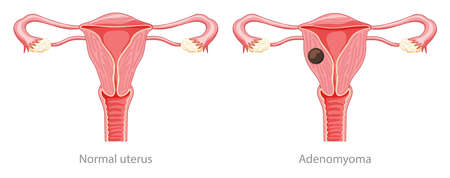 Adenomyoma Adenomyosis Human anatomy Female Sick and normal reproductive system organs. Location scheme Cross section uterus, cervix, ovary, fallopian tube icon. Vector illustration isolated on whiteのイラスト素材
