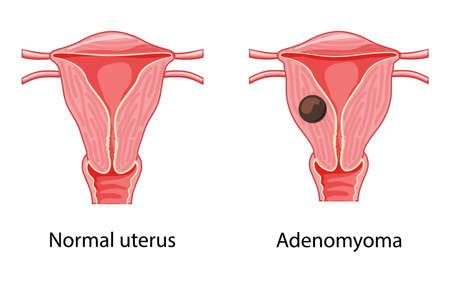 Adenomyoma Adenomyosis Human anatomy Female reproductive Sick and normal system organs. Location scheme uterus icon. Vector medical Cross section disease illustration isolated on white backgroundのイラスト素材