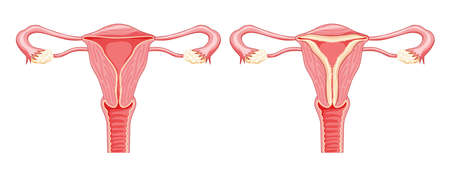 Set of Endometrial hyperplasia Female reproductive system in normal and problem uterus. Front view in a cut. Human anatomy internal organs diseases location scheme flat style iconのイラスト素材