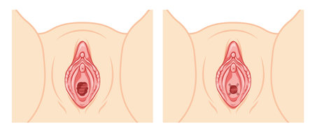 Hymenoplasty before and after Hymen repair restoration revirginization reproductive system uterus. Front view. Human Surface anatomy of perineum external organs scheme, vagina vulva flat style iconのイラスト素材