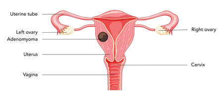 Adenomyoma Adenomyosis with inscriptions, Human anatomy Female reproductive Sick system organs. Structure of uterus, cervix, ovary, fallopian tube in Latin text. Frontal view Vector illustrationのイラスト素材