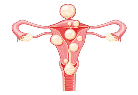Uterine fibroids Female leiomyomas reproductive system uterus. Front view. Human anatomy medical illustration isolated internal organs location scheme, cervix, ovary, fallopian tube flat style iconのイラスト素材