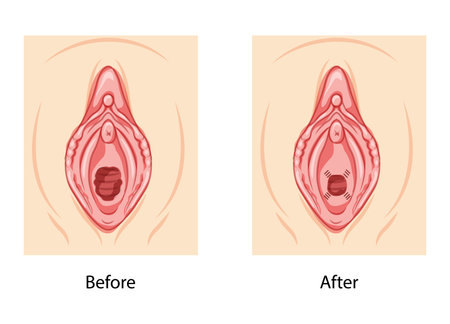 Hymenoplasty before and after Hymen repair restoration revirginization reproductive system uterus. Front view. Human Surface anatomy of perineum external organs scheme, vagina vulva flat style iconのイラスト素材