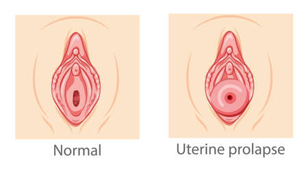 Set of uterine prolapse Female reproductive system women perineum uterus normal and with disease pain. Human anatomy external organs flat style icon. Vector medical illustration concept isolatedのイラスト素材