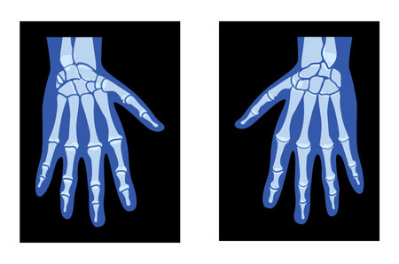 X-Ray Hands Skeleton Human body, Bones adult people roentgen back view - Metacarpals, Phalanges 3D realistic flat blue color concept Vector illustration of medical anatomy isolated on black backgroundのイラスト素材