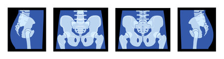 Set of X-Ray pelvis Skeleton Hip Human body Bones adult people roentgen front back side view. 3D realistic flat blue color concept Vector illustration of medical anatomy isolated on black backgroundのイラスト素材