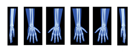 Set of X-Ray Hands with Radius, Ulna Skeleton Human body, Bones adult people roentgen front back side view. 3D realistic flat blue color concept Vector illustration of medical anatomy isolatedのイラスト素材